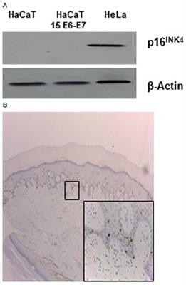 Beta HPV Type 15 Can Interfere With NF-κB Activity and Apoptosis in Human Keratinocytes